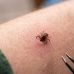 Tick Bite on a hand and tweezers to remove it
