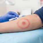 Lyme disease bullseye rash tick bite NJ